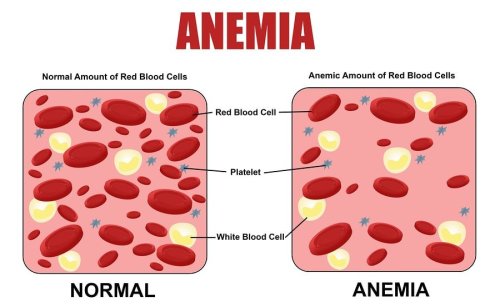 bigstock-anemia-diagram-115481906-min