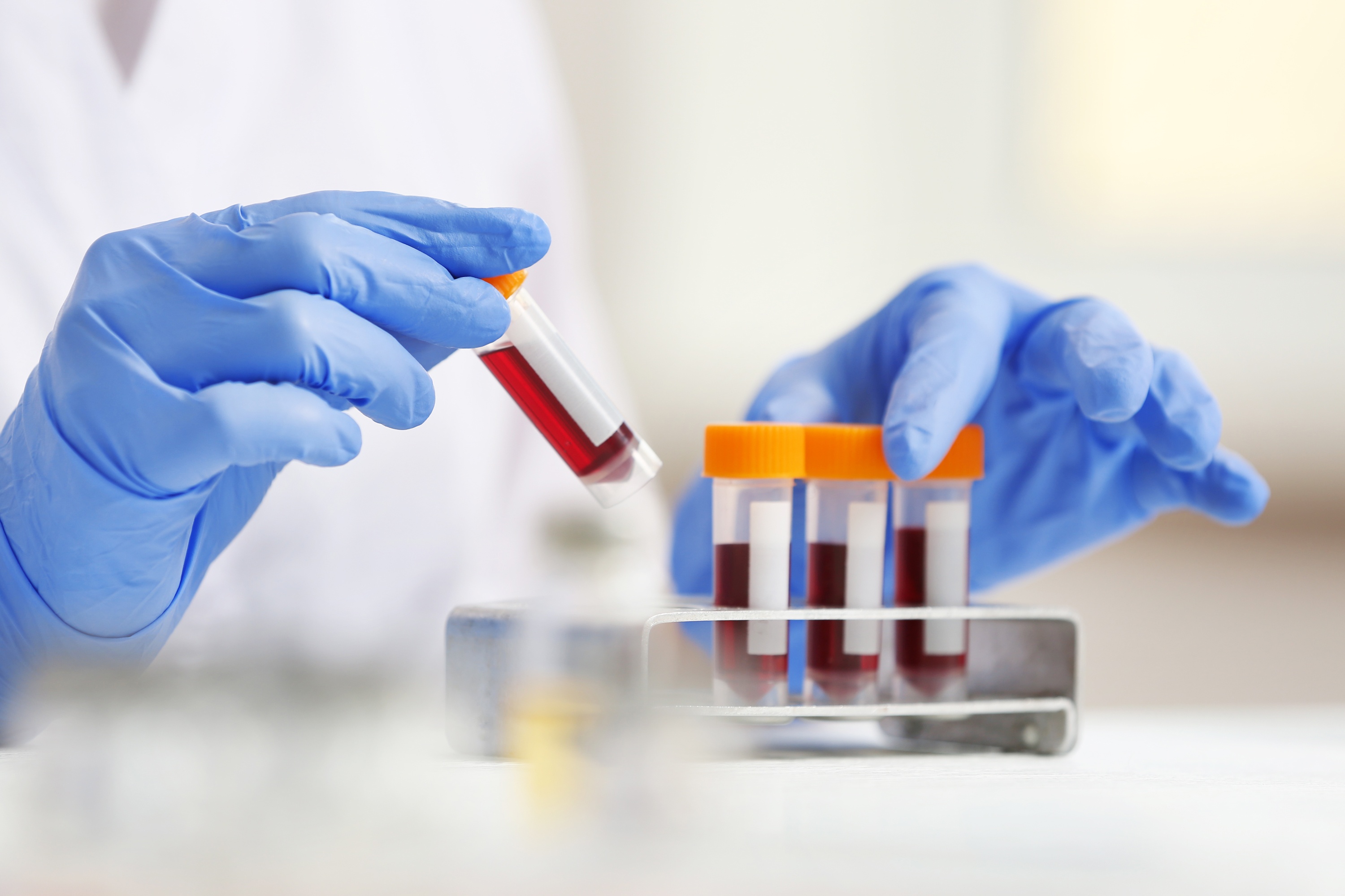 C Reactive Protein (CRP) Blood Test